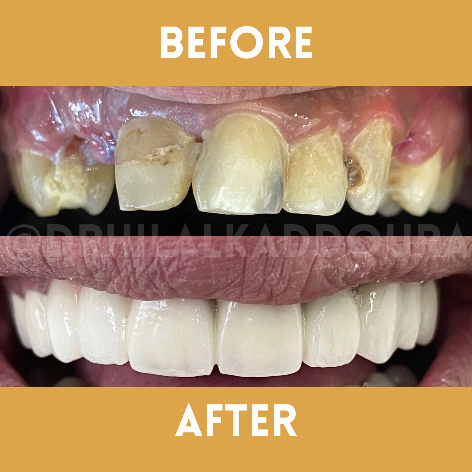 Dental Implants Lebanon Bekaa beqaa