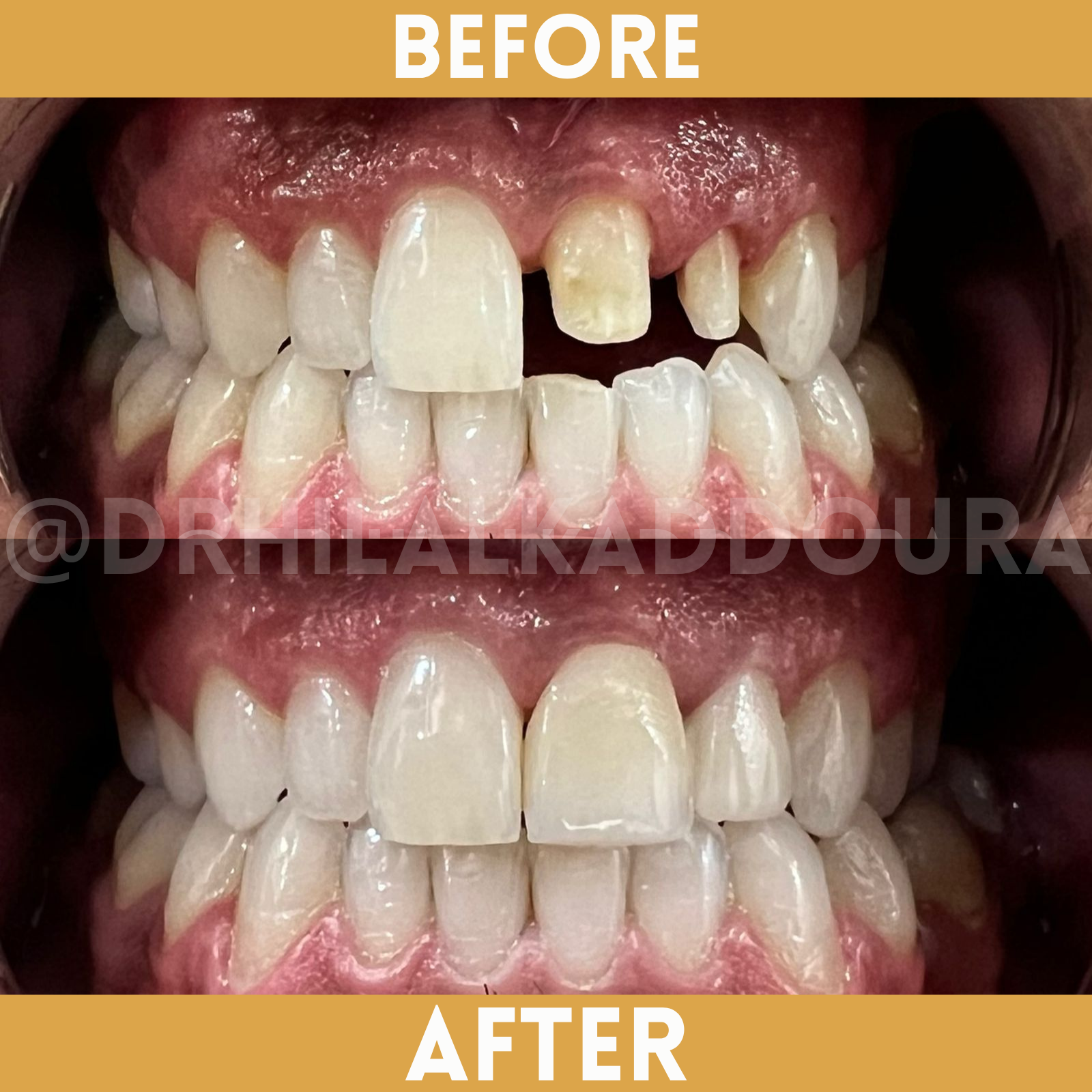 Dental Implants Lebanon