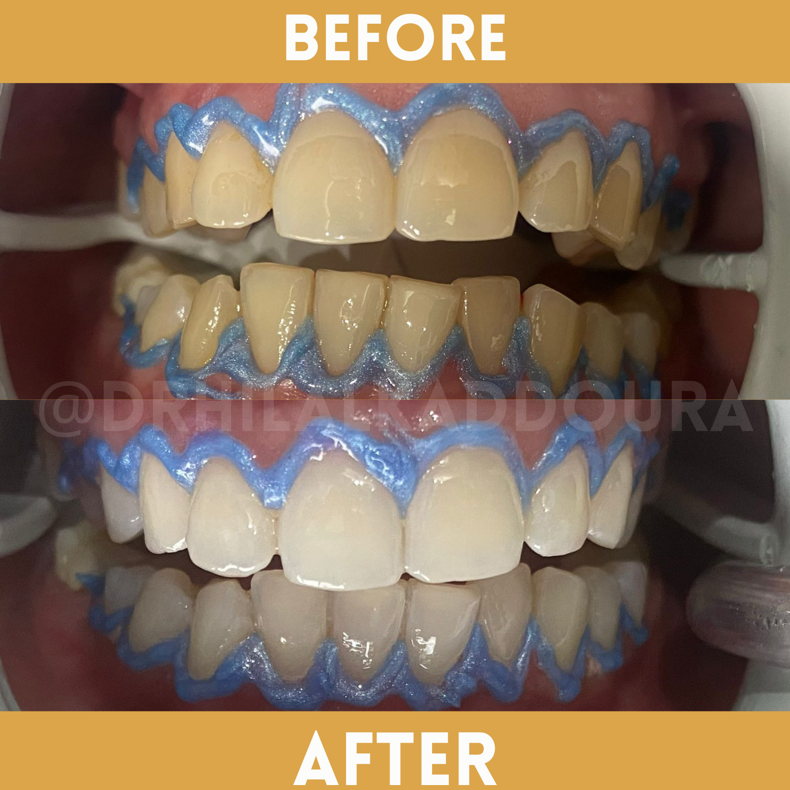 Teeth Whitening Lebanon