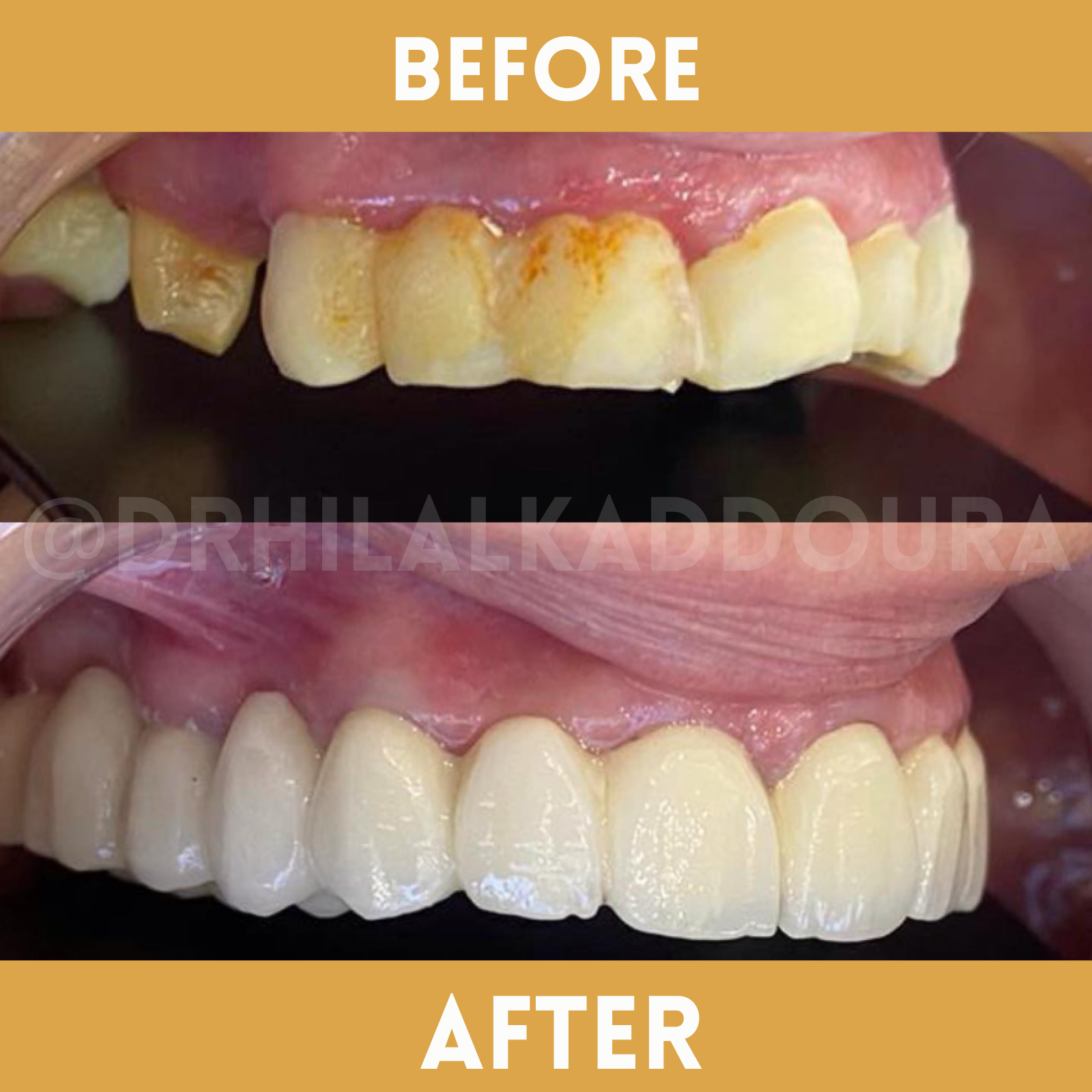 Teeth Whitening Lebanon