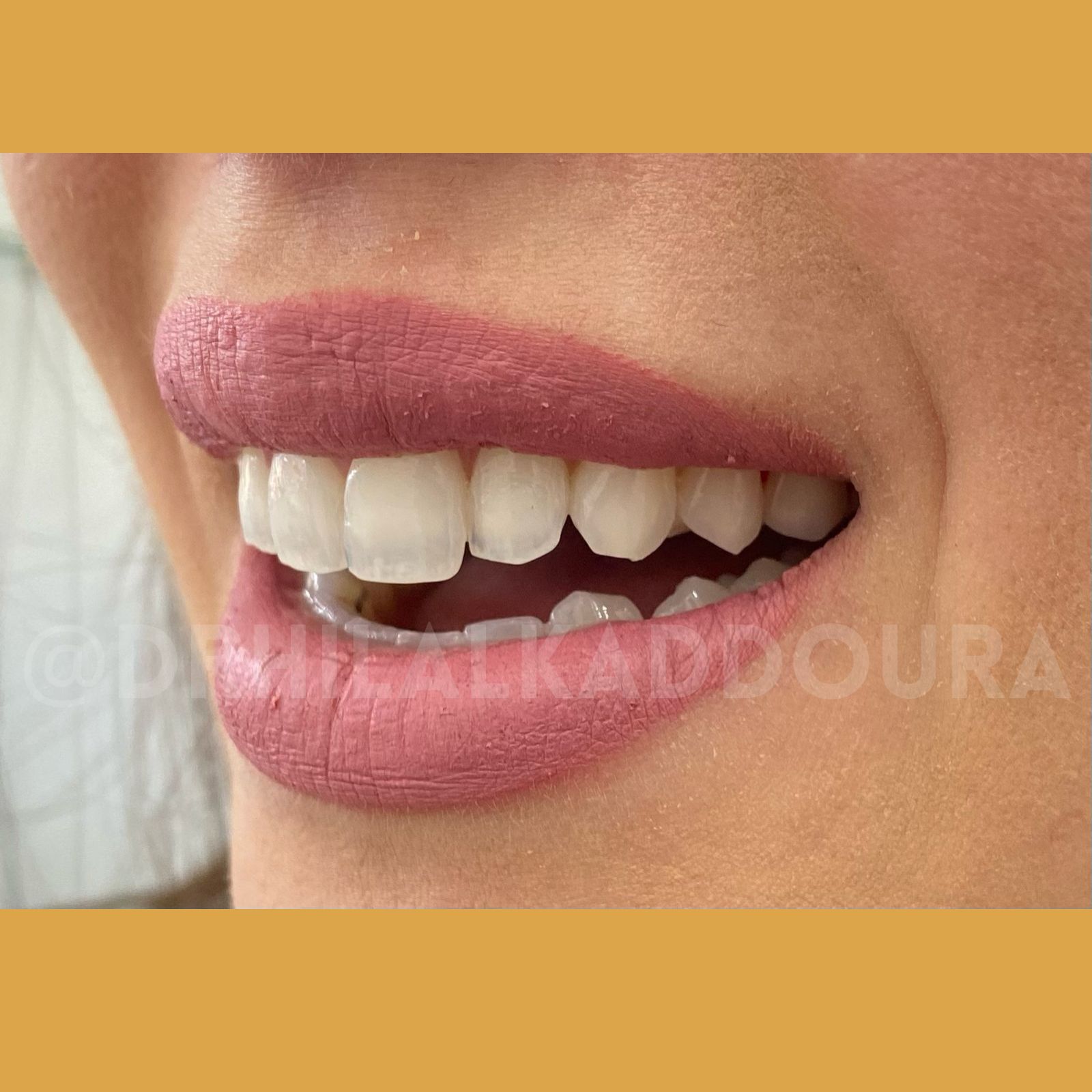 Teeth Whitening Lebanon