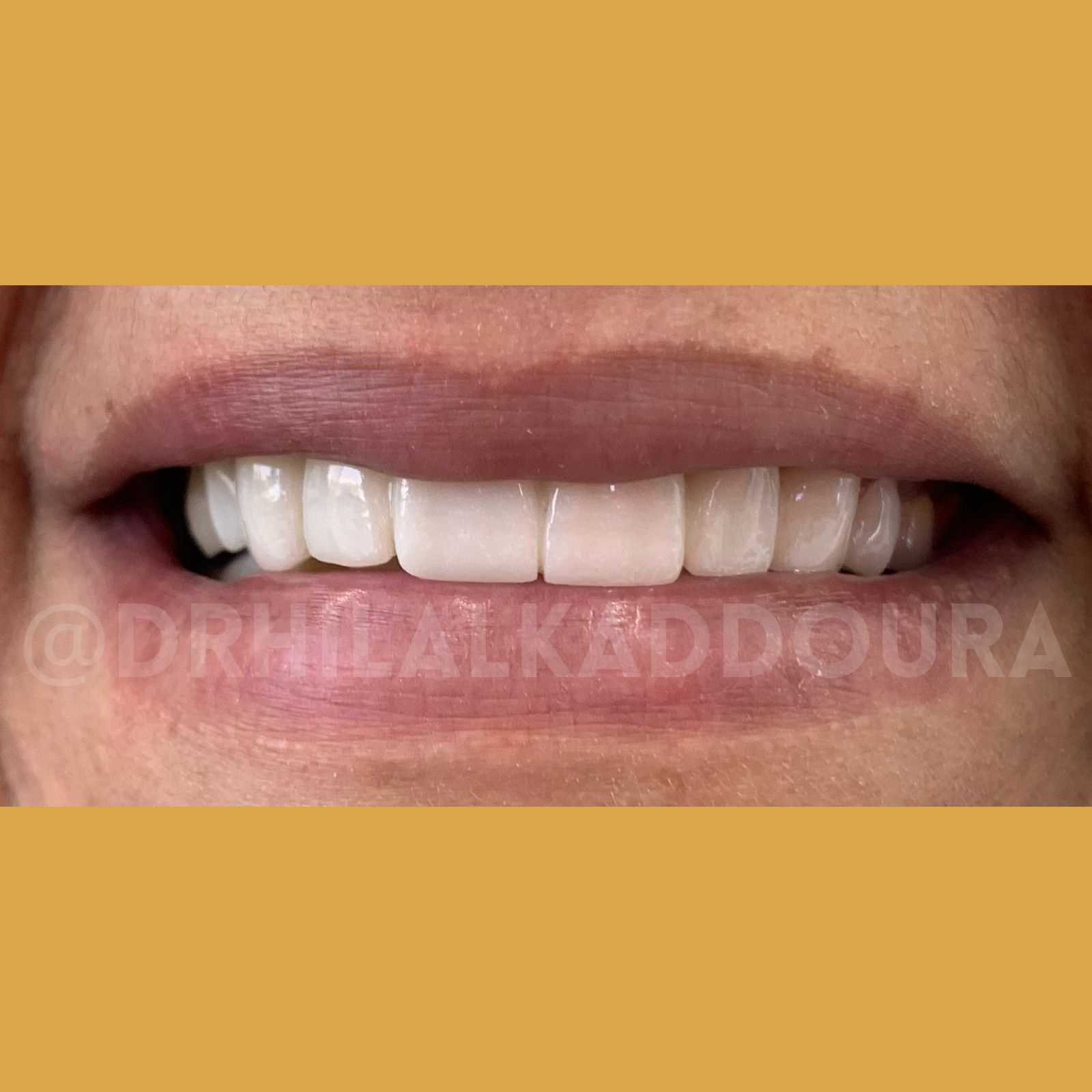 Teeth Whitening Lebanon