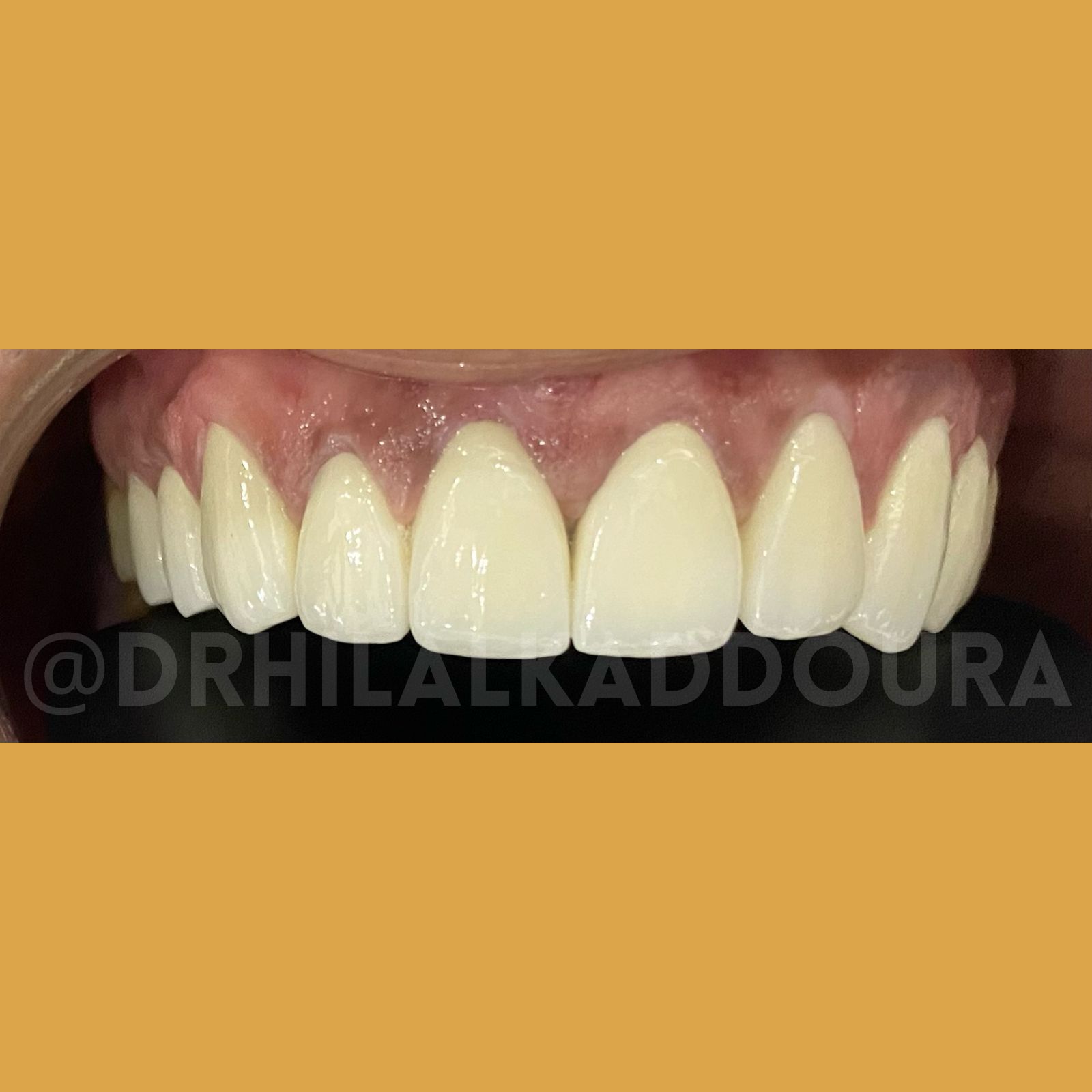 Teeth Whitening Lebanon