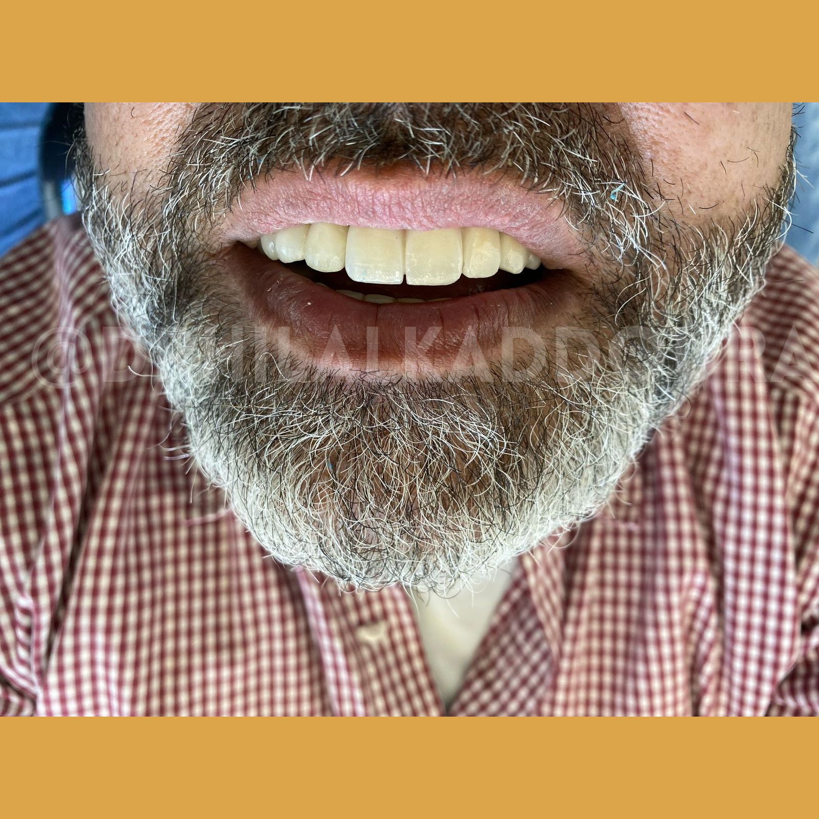 Dental Implants Lebanon
